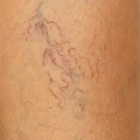 Сосудистые «звёздочки» и паутинки на ногах