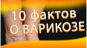 10 фактов о варикозе