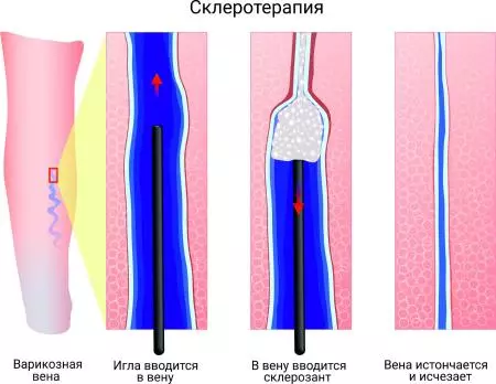 Что такое склеротерапия