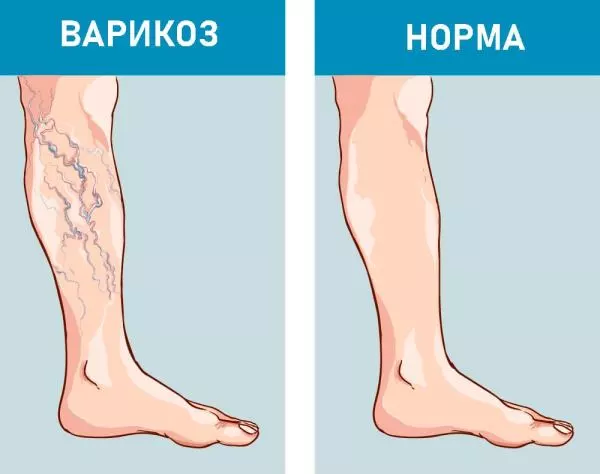 варикоз