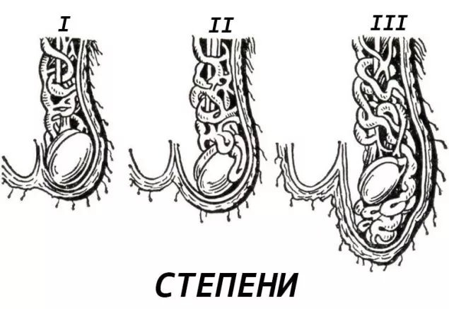 варикоцеле 4 ступеня фото