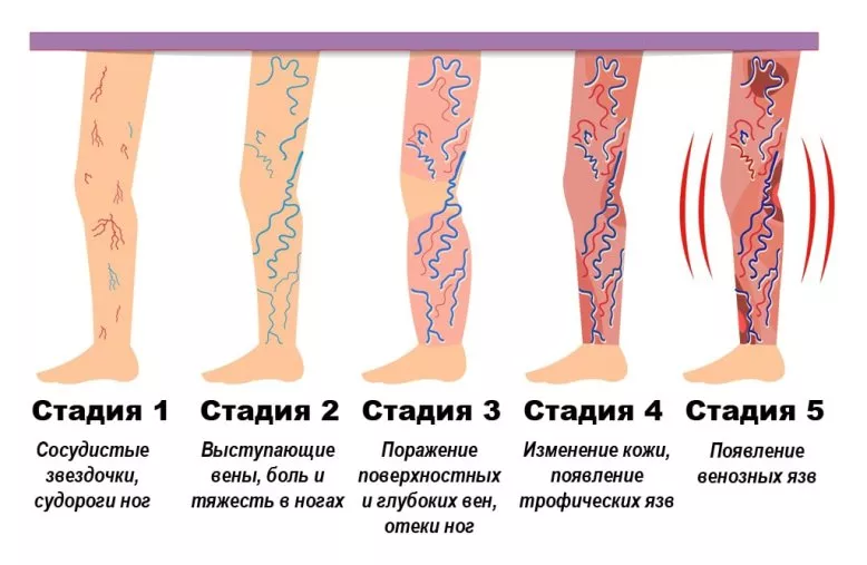 тромбофлебиты - стадии