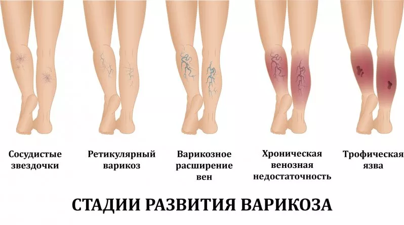 венозные трофические язвы