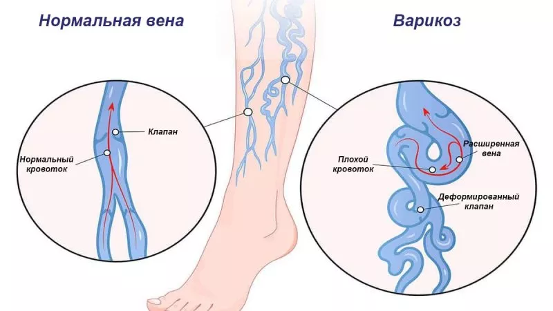 судини при варикозі