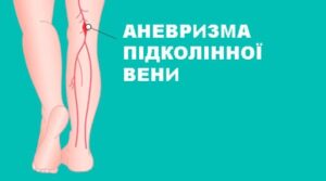 Аневризма нижних конечностей