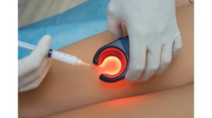 Бесследное устранение вздутых вен — и это только одно из преимуществ Foam-Form склеротерапии