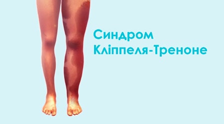 Синдром Клиппеля-Треноне