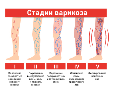 Методи лікування запущеного варикозу вен