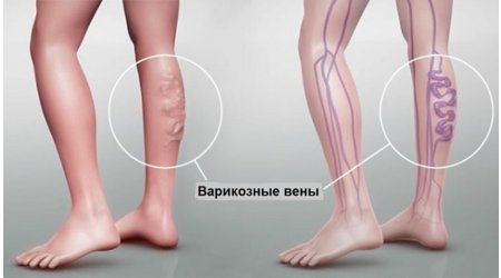 Як своєчасно виявити варикоз за 8 характерними ознаками