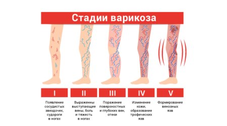 Стадії варикозу нижніх кінцівок