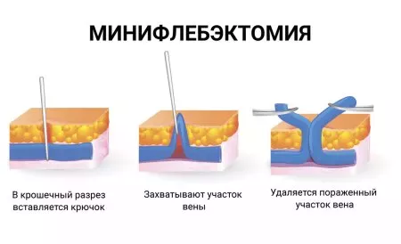 флебектомія реабілітація після операції