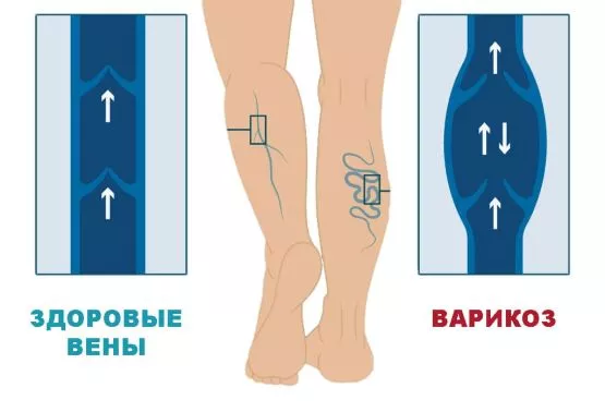 недостатність перфорантних вен