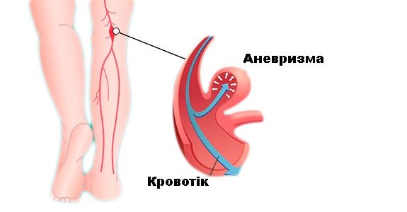 венозна аневризма