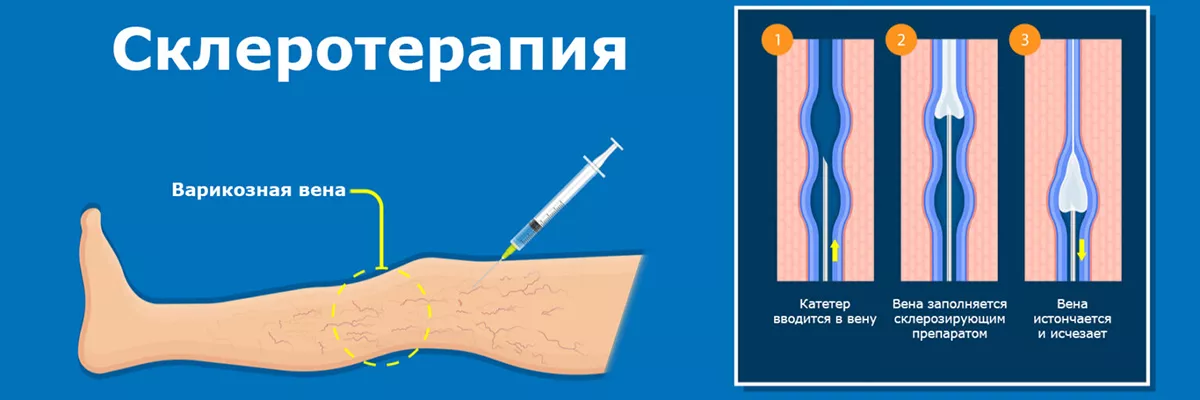 Як виконується склеротерапія