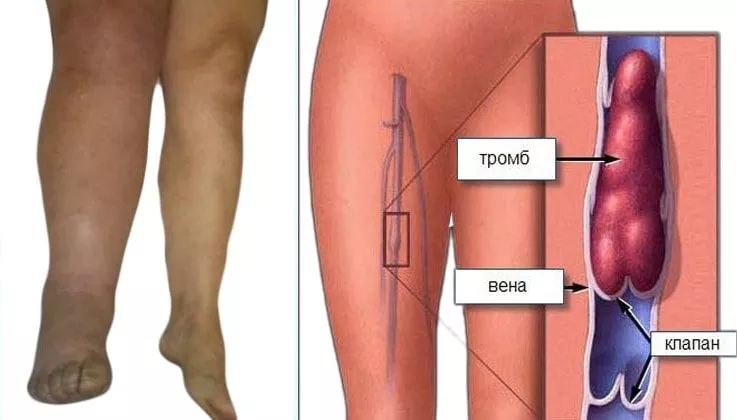 ілеофеморальний тромбоз глибоких вен