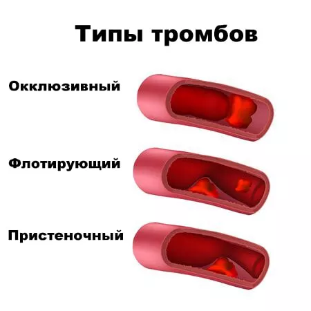 оклюзійний тромбоз