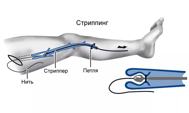 птфс вен