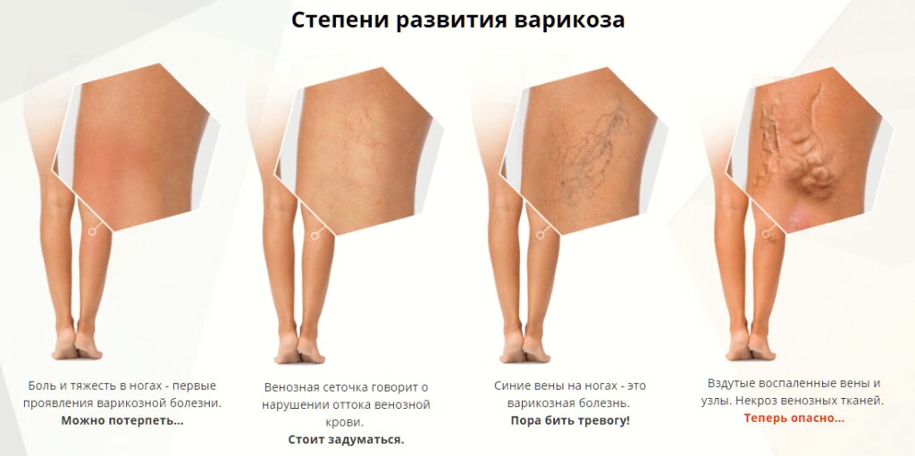 стадии развития варикоза