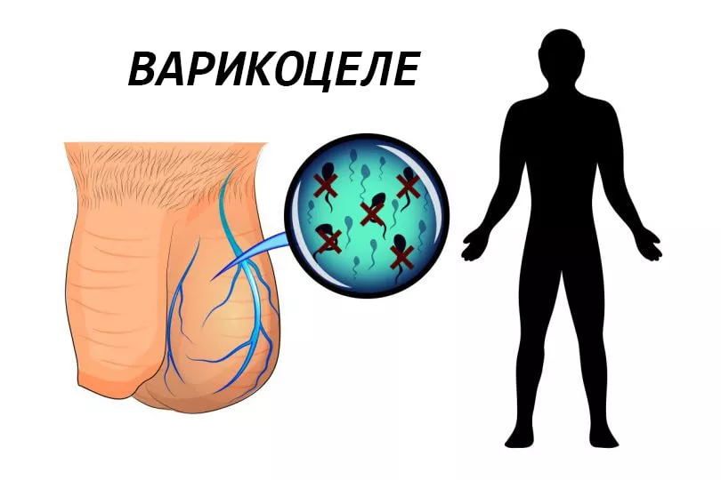 наслідки варикоцеле у чоловіків