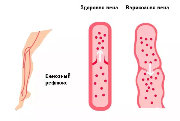 рефлюкс вени