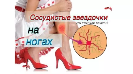 Як позбутися судинних зірочок і запобігти їх появі
