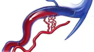 Артериовенозные фистулы