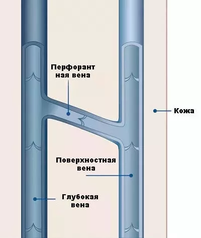 перфорантна вена