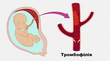 Наследственная тромбофилия