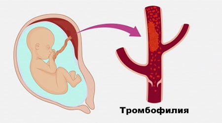 Наследственные тромбофилии