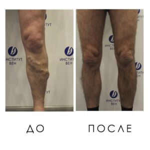 Склерооблитерация До и После